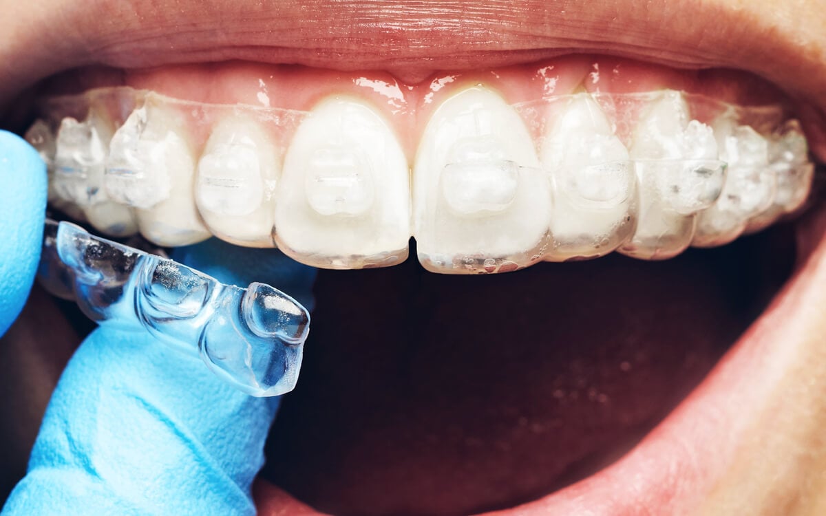 Six Month Smiles Guided Orthodontics for the General Dentist